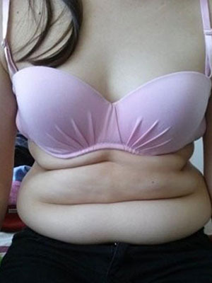 北京常好麗格腰腹吸脂后20天的感受 恢復(fù)日記來(lái)咯~