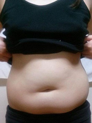 北京常好麗格腰腹吸脂后20天的感受 恢復(fù)日記來(lái)咯~