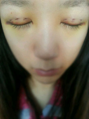 北北京常好麗格三點定位雙眼皮恢復一個月經(jīng)歷