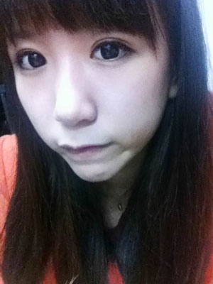 北北京常好麗格三點定位雙眼皮恢復一個月經(jīng)歷