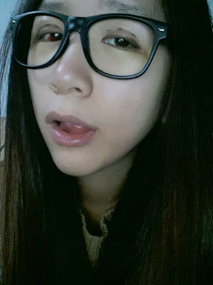 北北京常好麗格三點定位雙眼皮恢復一個月經(jīng)歷