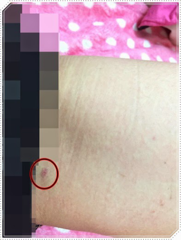 自體脂肪豐胸讓我的小平胸變成大豪乳