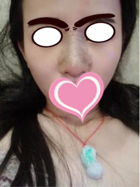 膨體隆鼻公改變了我塌鼻子的命運(yùn)