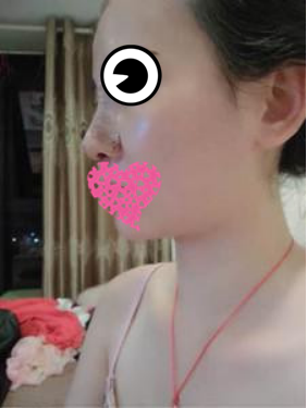 膨體隆鼻公改變了我塌鼻子的命運(yùn)