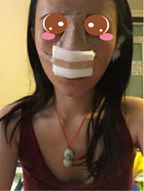 膨體隆鼻公改變了我塌鼻子的命運(yùn)