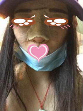 膨體隆鼻公改變了我塌鼻子的命運(yùn)