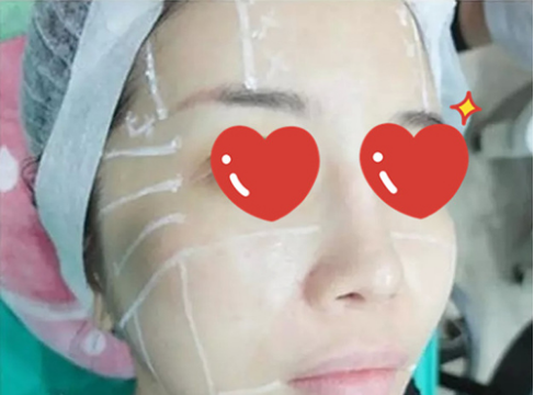 做了拉皮除皺 我的皮膚越來越緊致光滑了