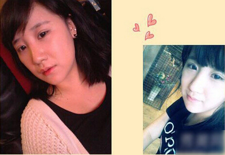 北京清木隆鼻+雙眼皮恢復(fù)日記