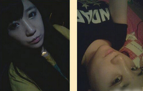 北京清木隆鼻+雙眼皮恢復(fù)日記