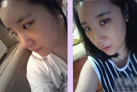 北京清木隆鼻+雙眼皮恢復(fù)日記