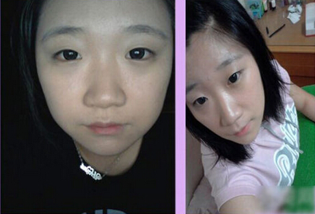 北京清木隆鼻+雙眼皮恢復(fù)日記