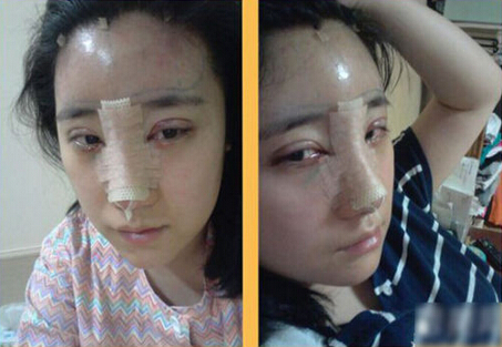 北京清木隆鼻+雙眼皮恢復(fù)日記