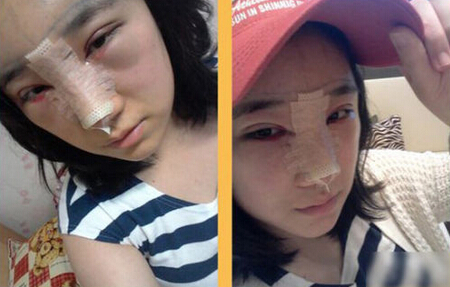 北京清木隆鼻+雙眼皮恢復(fù)日記