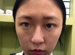 北京清木隆鼻整形后 **變身