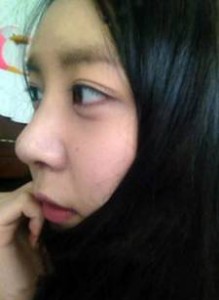 北京清木隆鼻整形后 **變身