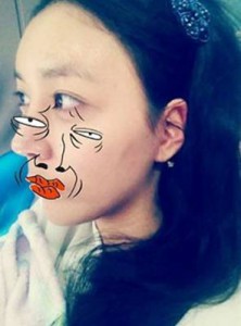 北京清木隆鼻整形后 **變身