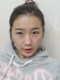 北京清木自體脂肪豐面頰2個月果分享