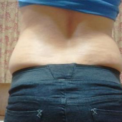 北京清木腰腹吸脂3個月感受