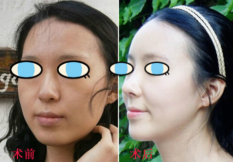 做了膨體隆鼻我也有了高鼻梁 **