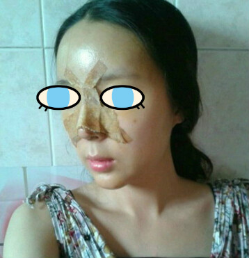 做了膨體隆鼻我也有了高鼻梁 **
