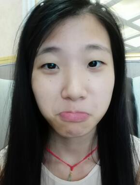 雙眼皮15天恢復記錄