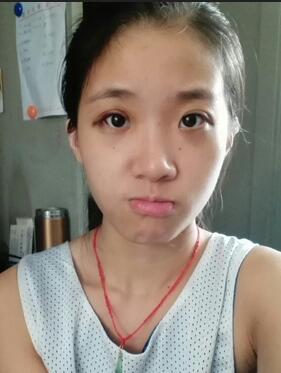 雙眼皮15天恢復記錄