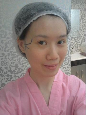 磨了下頜角和顴骨的我 變成小仙女了