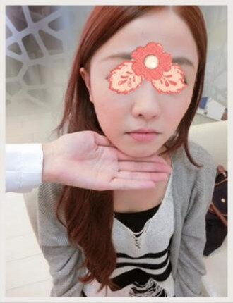 埋埋蛋白線(xiàn).提升拯救了我的大小臉和皮膚下垂