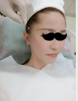 埋埋蛋白線(xiàn).提升拯救了我的大小臉和皮膚下垂