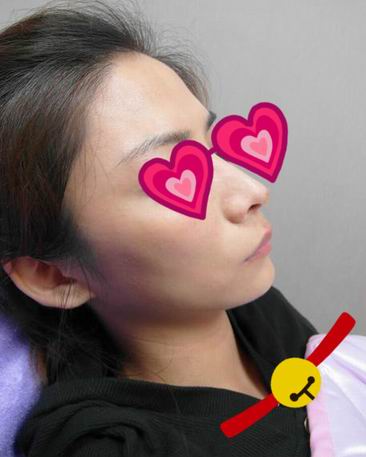 Misko隆鼻讓我鼻子變得挺拔嬌俏無壓力