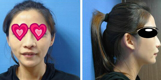 Misko隆鼻讓我鼻子變得挺拔嬌俏無壓力