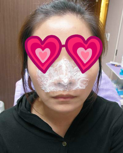 Misko隆鼻讓我鼻子變得挺拔嬌俏無壓力