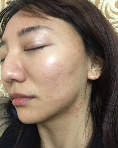 北京歐華去痘坑痘印兩個月