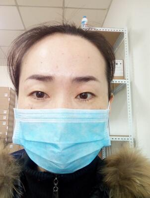 激光祛斑20天后的圖片 北京歐華王芳