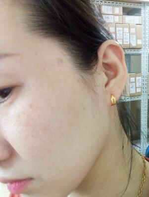 激光祛斑20天后的圖片 北京歐華王芳