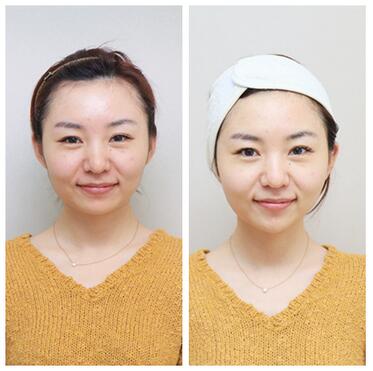 我做射頻緊膚經(jīng)歷 醫(yī)師:北京歐華王芳