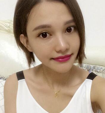 玻尿酸豐太陽7天果圖 愛悅麗格豐太陽穴一個月啦~