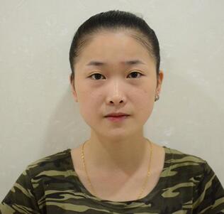 愛(ài)悅麗格玻尿酸豐蘋(píng)果肌、豐下巴、隆鼻