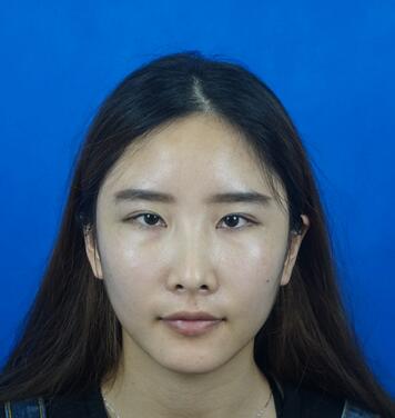 愛(ài)悅麗格膠原蛋白豐蘋(píng)果肌分享