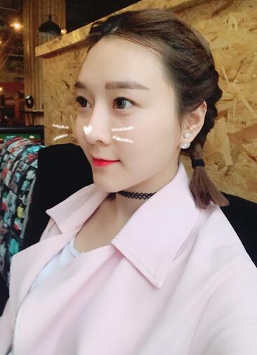 武漢中愛自體脂肪豐唇+面部填充恢復(fù)記錄