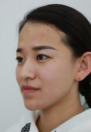 梨花雨注射注射瘦臉去眉間紋日記