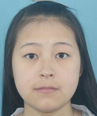 梨花雨割雙眼皮恢復(fù)半年了