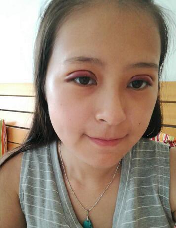 梨花雨割雙眼皮恢復(fù)半年了