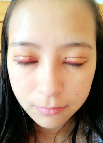 梨花雨割雙眼皮恢復(fù)半年了