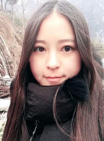 梨花雨割雙眼皮恢復(fù)半年了