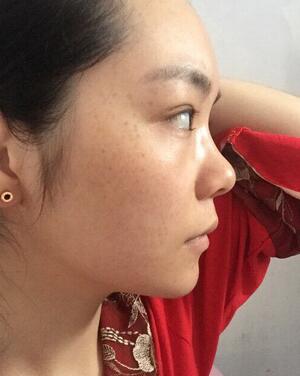 梨花雨隆鼻整形的恢復(fù)經(jīng)歷