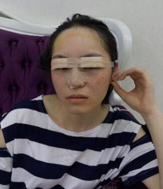 梨花雨隆鼻整形的恢復(fù)經(jīng)歷