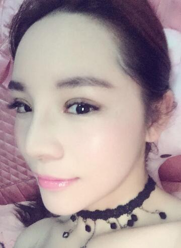 梨花雨隆鼻整形的恢復(fù)經(jīng)歷