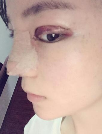 梨花雨隆鼻整形的恢復(fù)經(jīng)歷