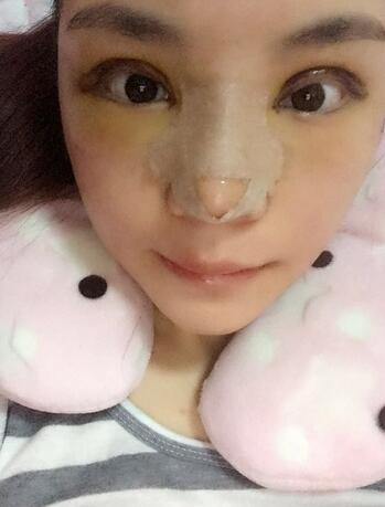 梨花雨隆鼻整形的恢復(fù)經(jīng)歷